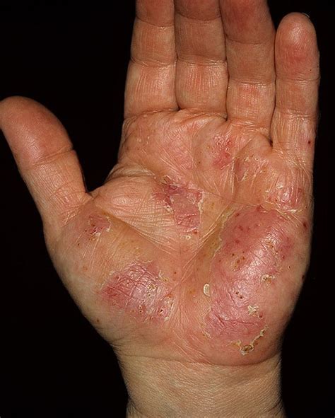 Different Types Of Eczema On Fingers