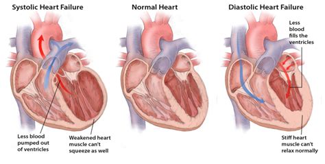 Heart Failure Cardiology Tasmania