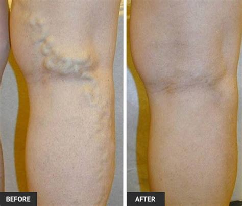 Varicose Veins These Symptoms Include Leg Pain Or Cramping Swelling