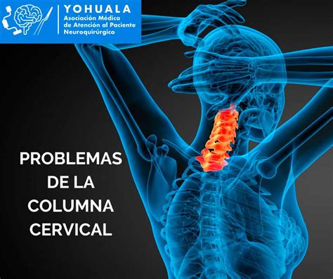 Problemas De La Columna Cervical Neurocirujano En Cuernavaca