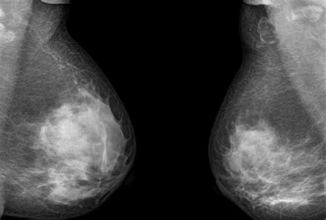 double mastectomies for breast cancer tripled in last decade