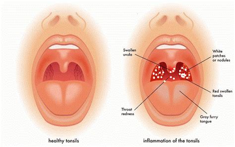 How To Get Rid Of White Spots On Tonsils Causes And Home