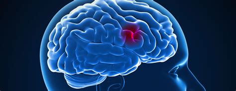 Dos And Donts When Someone Is Having A Stroke Regency Medical Centre