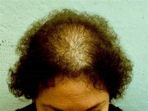 Health From Trusted Sources Hair Loss Alopecia