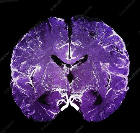 Coronal Brain Slice Specimen Stock Image C0370792 Science Photo