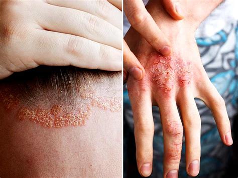 Symptoms — overview covers definition and possible causes of peeling skin. What are the reasons for peeling of feet skin - lifealth