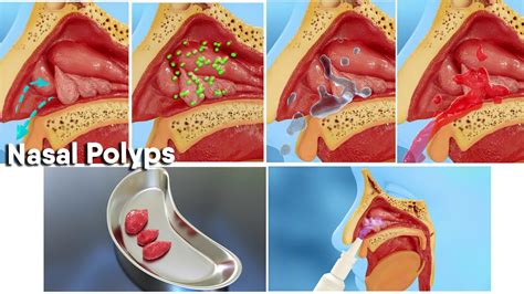 Nasal Polyps Removal Surgery Youtube Nasal Polyp Surgery Popping Sexiz Pix