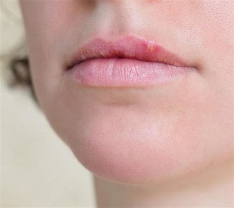 How Does Oral Herpes Spread 6 Steps