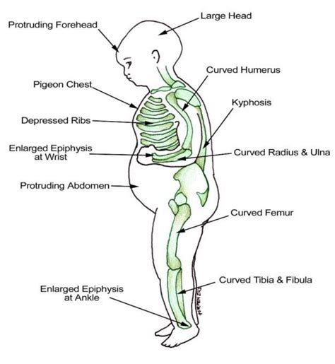 Rickets In Adults Treatment