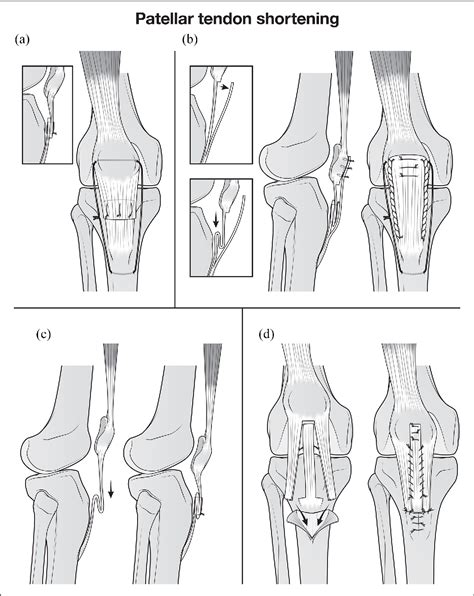 Distal Femoral Extension Osteotomy And Patellar Tendon Advancement Or