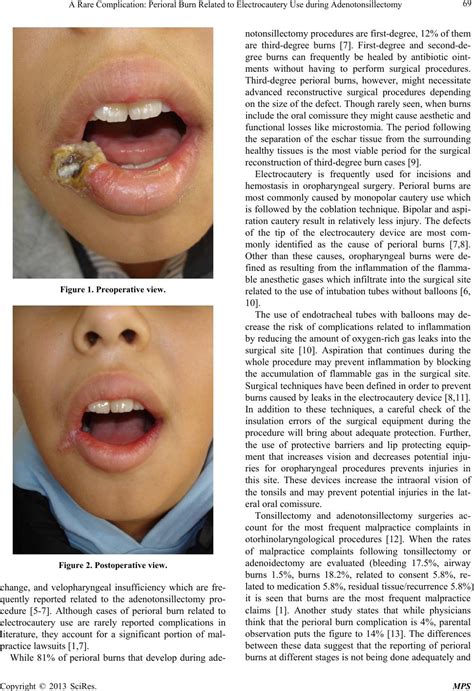 A Rare Complication Perioral Burn Related To Electrocautery Use During