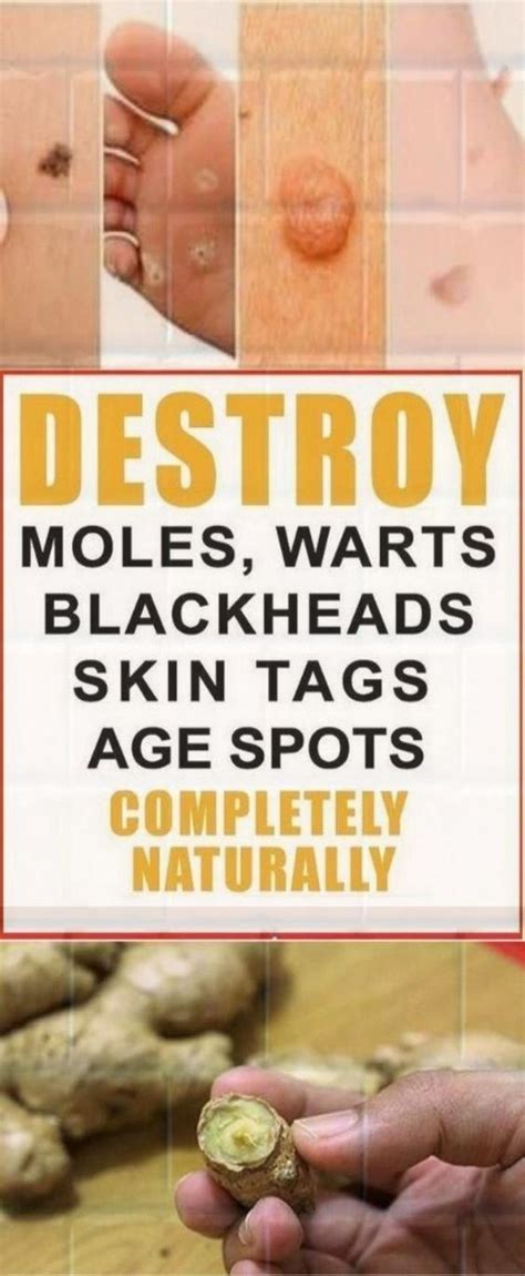 how to get rid of warts moles age spots and skin tag using natural remedies skin tag mole