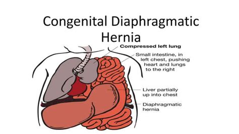 Congenital Diaphragmatic Hernia Ppt