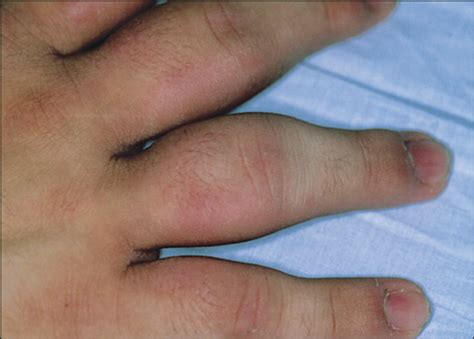 Acquired Fusiform Swelling Of The Fingers—quiz Case Radiology Jama