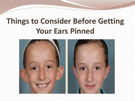Things To Consider Before Getting Your Ears Pinned