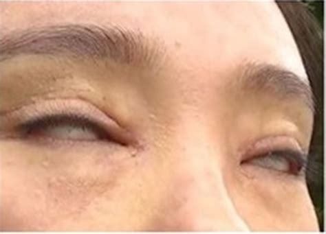 Woman Unable To Fully Close Her Eyes After Botched Double Eyelid Surgery