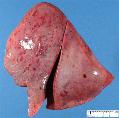 systemic fungal infection - Humpath.com - Human pathology