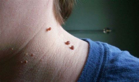 The Simple Way To Treat And Remove Blackheads Age Spots Warts Moles And