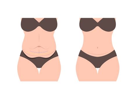 Você sabe a diferença entre abdominoplastia e mini abdominoplastia