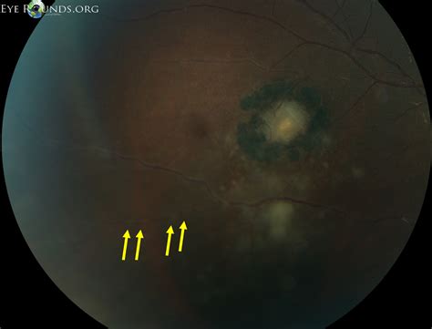Atlas Entry Ocular Toxoplasmosis