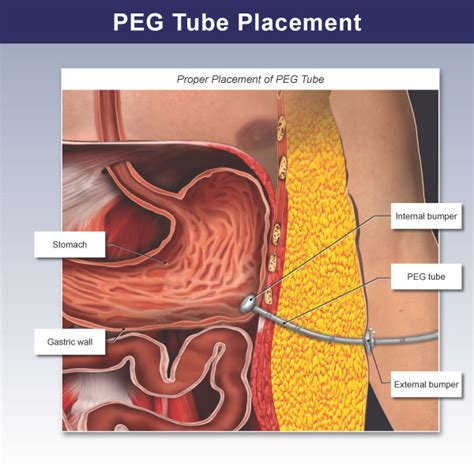 Peg Tube Placement Illustration Trialexhibits Inc