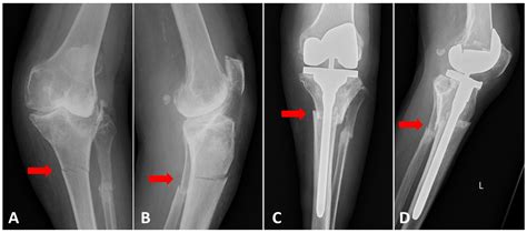 Jcm Free Full Text Shaft Fractures In Patients Requiring Primary Or