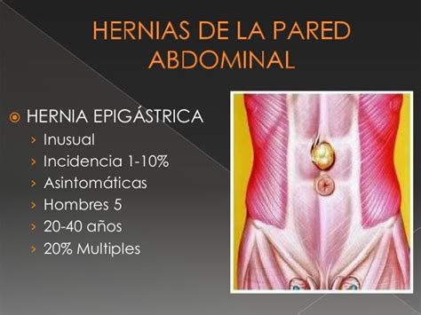 Hernias De La Pared Abdominal