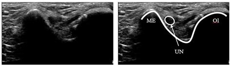 Ultrasound Measurements And Assessments Of The Ulnar Nerve At The Elbow