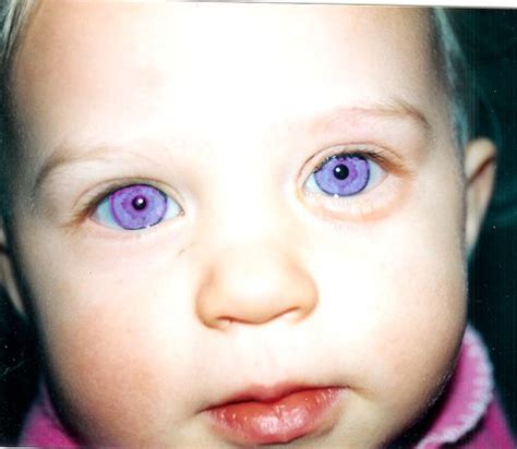 violet eyes natural albino