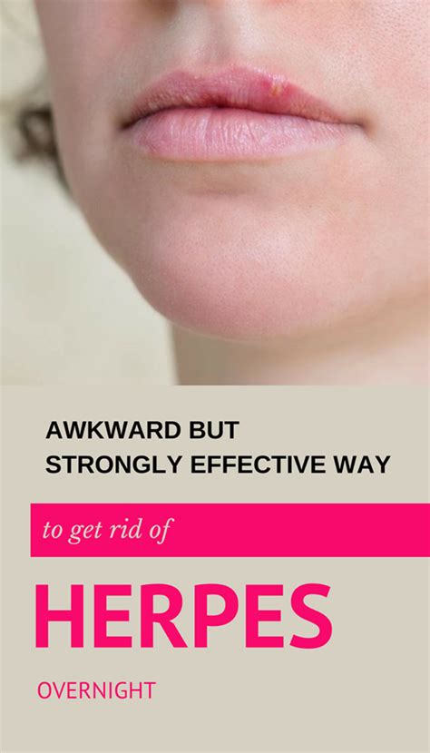 Pin On Cold Sore