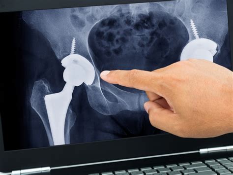 types of hip replacement surgery