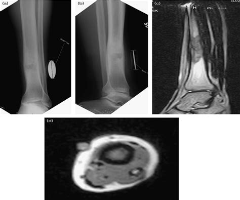 Ewing Sarcoma Of The Tibia Mimicking Fibrous Dysplasia Journal Of Pediatric Orthopaedics B