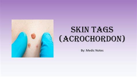 Skin Tags Causes And Pathophysiology Youtube