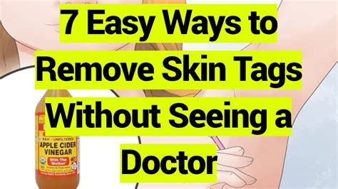 7 easy ways to remove skin tags without seeing a doctor youtube