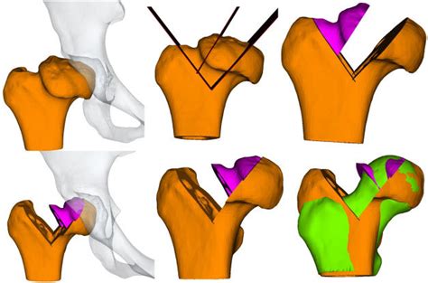 Pre Operative Computerized Planning Simulation Of The Femoral Head
