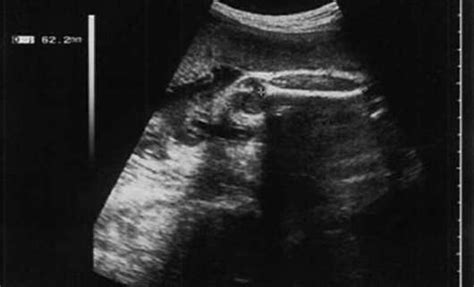 Nt screening test and the same time. Femur length ultrasound dating || Recipes-chairs.ml