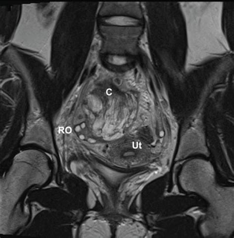 Mri Of The Pelvis A 11 Axial T2 Weighted Image Demonstrating The