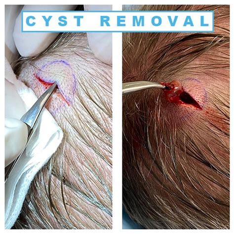 Cyst Removal Midland Skin