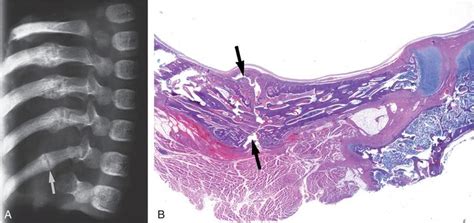 Bony thoracic trauma | Radiology Key