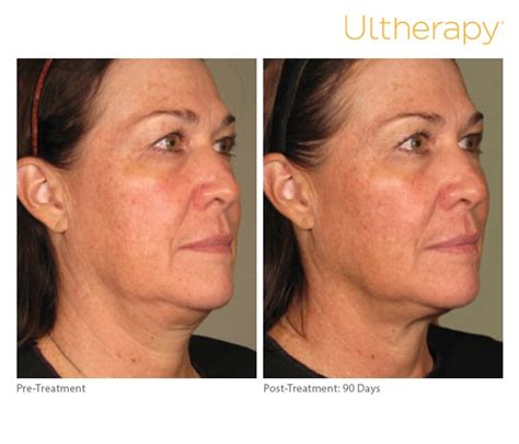 Ultherapy Long Island Best Long Island Ultherapy
