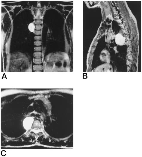 Diagnostic Magnetic Resonance Imaging T2 Weighted Of The Thoracic