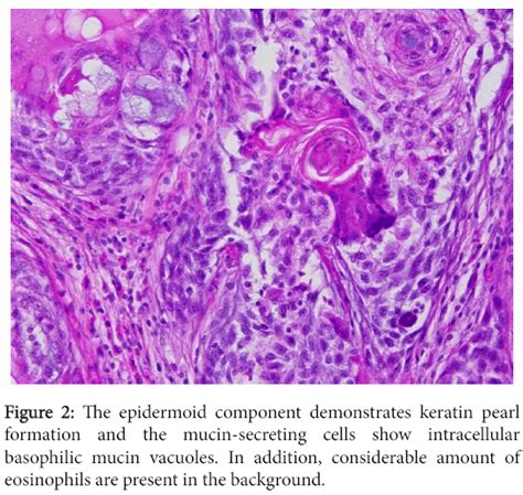 Medical Surgical Pathology Epidermoid Component Demonstrates Keratin