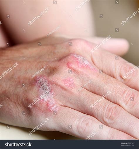 Severe Psoriasis Psoriasis On Handbones Closeup Stock Photo 67707349