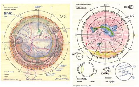 Retinal Detachment Fundus Diagram Aflam Neeeak