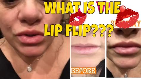 Lip Flip The Best Alternative To Lip Fillers Daily Pics And Video