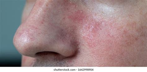 Psoriasis Allergic Rash On Skyn Face Stock Photo 1642998904 Shutterstock