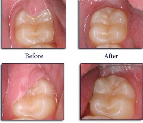 Operculectomy Dental And Oral Treatment In Dhaka Bangladesh