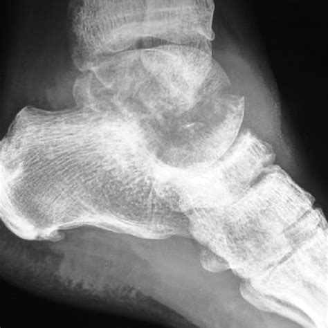 Mri Left Foot And Ankle A Image Showing Intraosseous Lesion