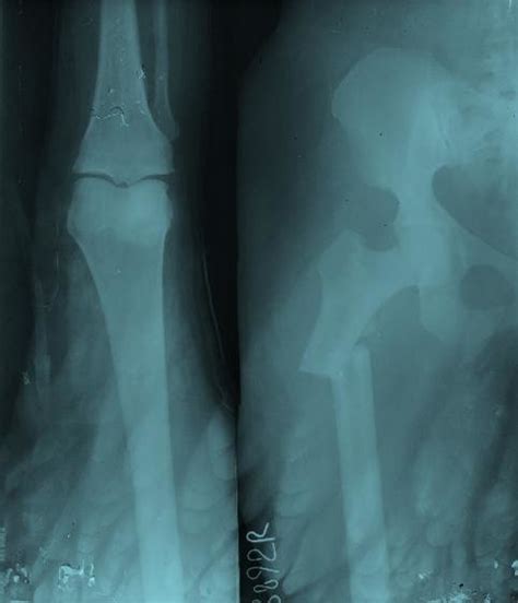 Radiograph Of Right Hip With Femur Showing Subtrochanteric Fracture Of