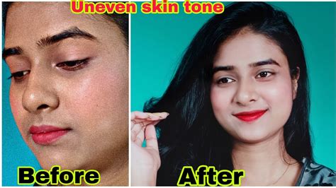 Diy For Uneven Skin Tone How To Reduce Sunburnacne Scars Hyper